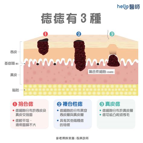 臉上長黑毛原因|痣形成的原因？痣長毛、痣變多變大是痣病變？5招判別